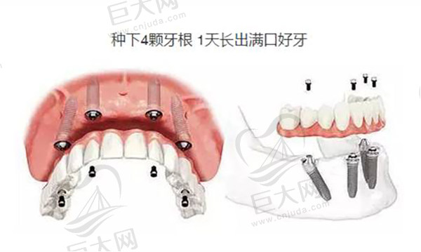 All-on-4 即刻种植修复技术