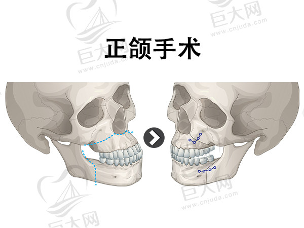 正颌外科手术