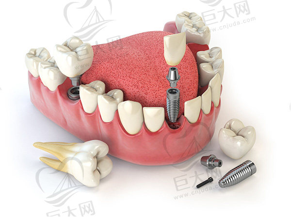 种植牙示意图