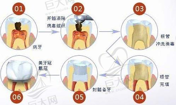 根冠治疗步骤过程图