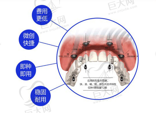 北京中诺口腔医院立得用微创种植优点