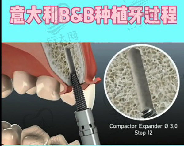 意大利B&B种植体