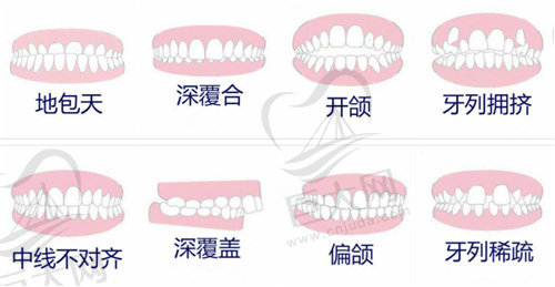 需要牙齿矫正的类型