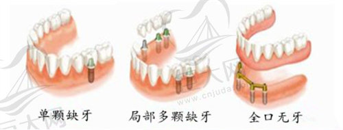 牙齿缺失类型