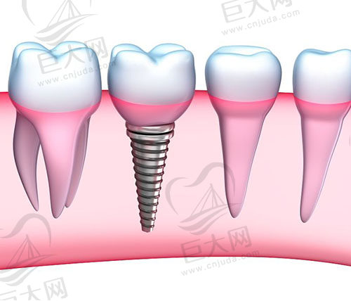 种植牙