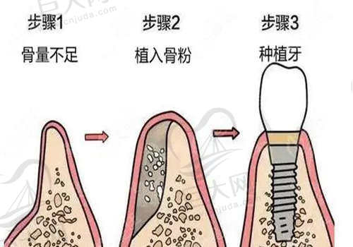 奥齿泰种植体