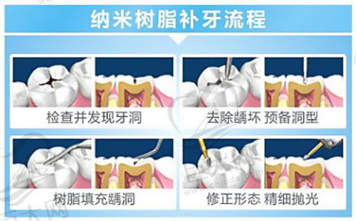 树脂补牙