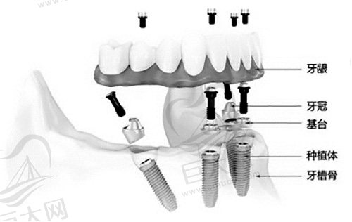 all-on-4牙齿种植
