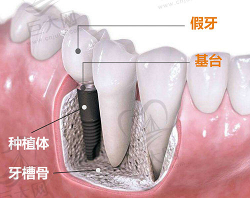种植牙.jpg