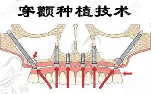 穿颧穿翼技术