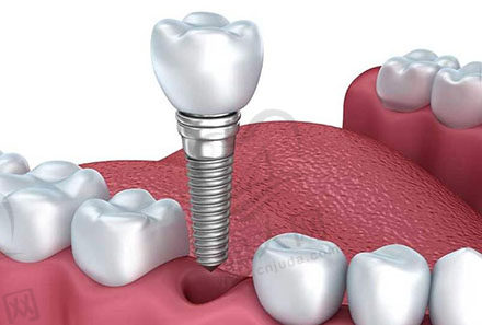 种植牙图片
