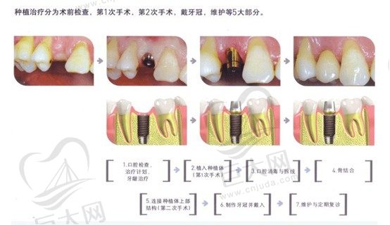 种植牙流程示意图