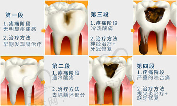 龋齿的形成