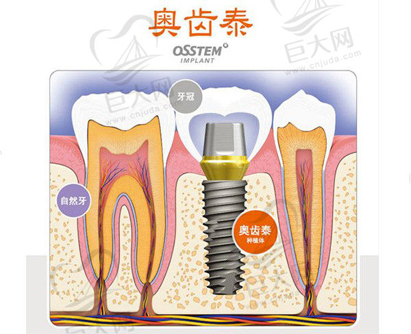 韩国奥齿泰种植牙