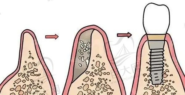 骨粉种植牙
