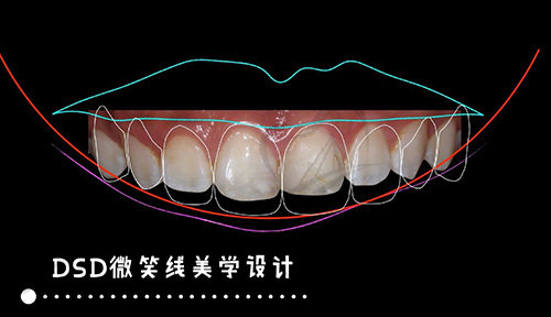 微笑线