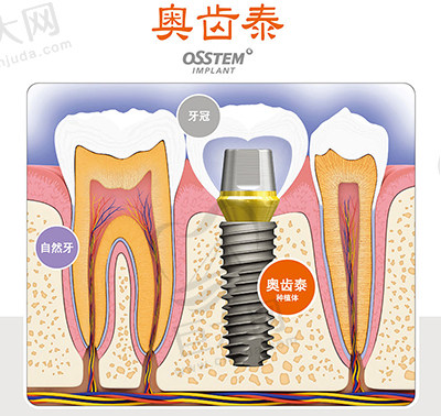 韩国奥齿泰种植牙