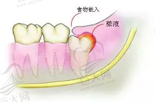 智齿每隔一段时间就发炎怎么办