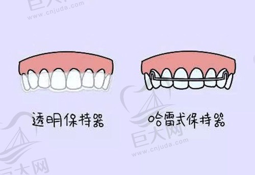 牙齿保持器类型