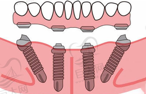 all-on-4种植牙修复示意图