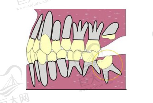 埋伏牙示意图