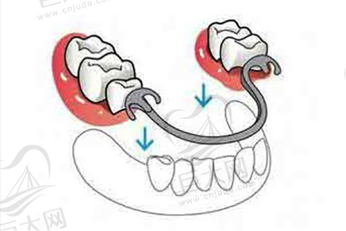 活动义齿佩戴示意图