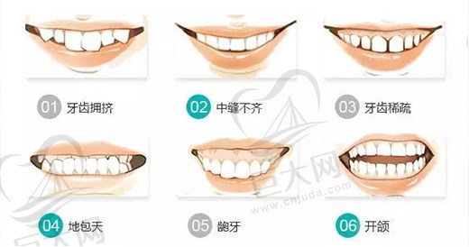 牙齿矫正的适用人群