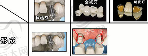 种植牙与烤瓷桥及全瓷桥的区别