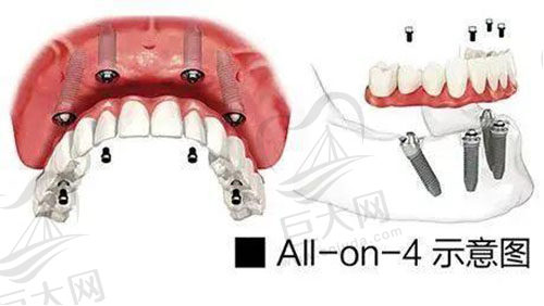 allon4示意图