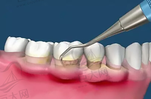 龈下刮治