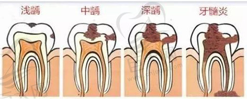 牙髓炎