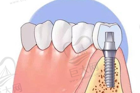 北京昌平罗兰口腔门诊-种植牙
