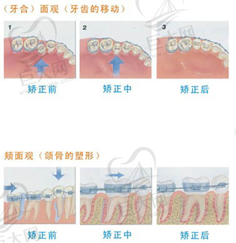 牙齿矫正示意图