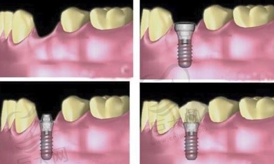 种植牙过程