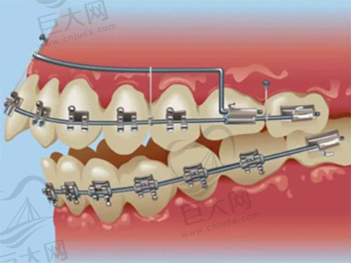 龅牙牙齿矫正图片