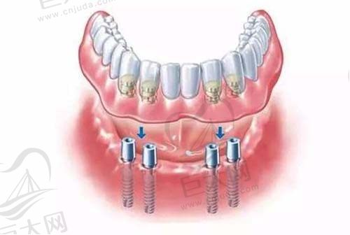 高难度all-on-4牙齿种植示意图