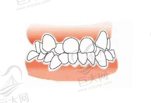 牙齿拥挤