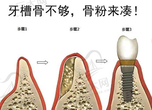 增骨手术