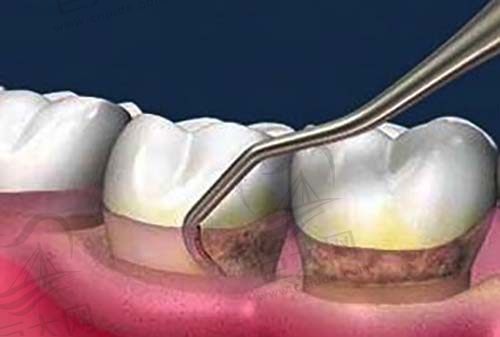 牙周刮治示范图