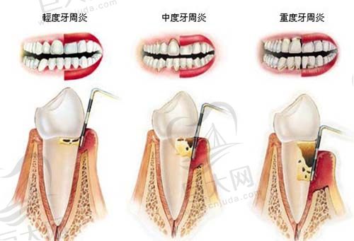 牙周炎发展过程