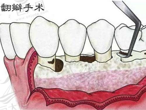 牙龈翻瓣手术