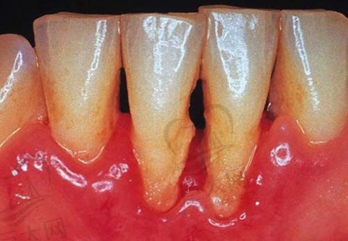 牙周疾病示意图