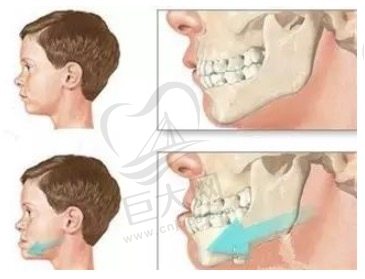 儿童地包天怎么矫正