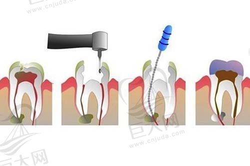牙齿根管治疗流程图