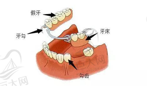 假牙图示