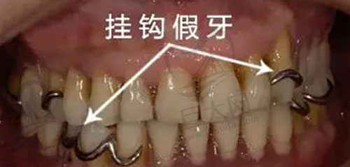 金属挂钩假牙