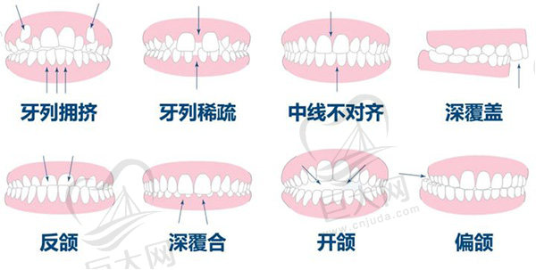 牙齿矫正多少岁合适