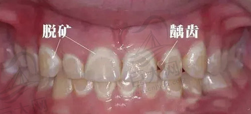 正畸后牙齿脱矿还有救吗