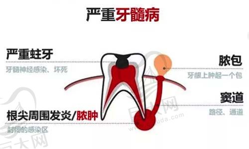 牙髓疾病示意图