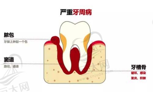 牙周疾病示意图